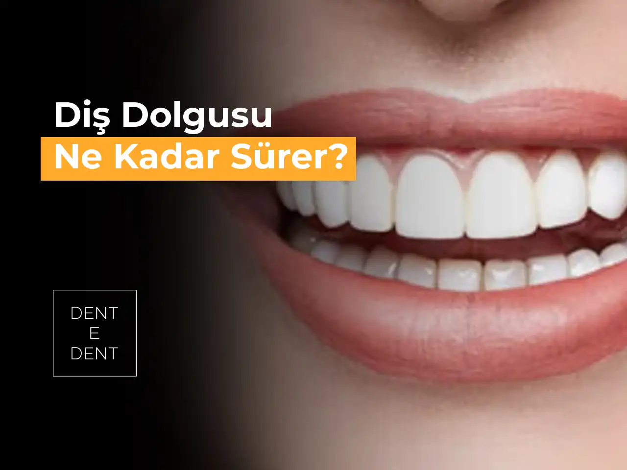 Diş Dolgusu Ne Kadar Sürer