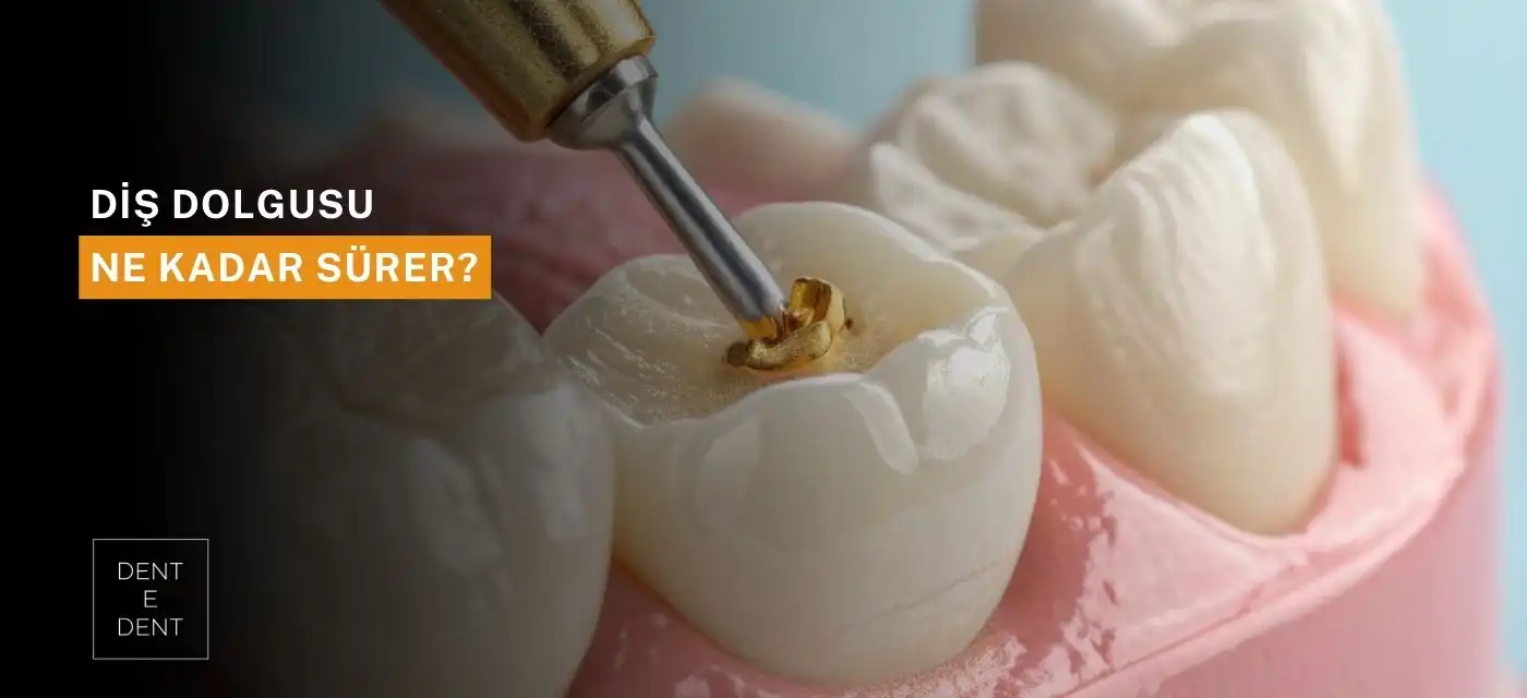 Diş Dolgusu Ne Kadar Sürer