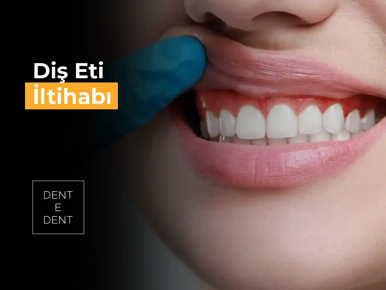 Diş Eti İltihabı