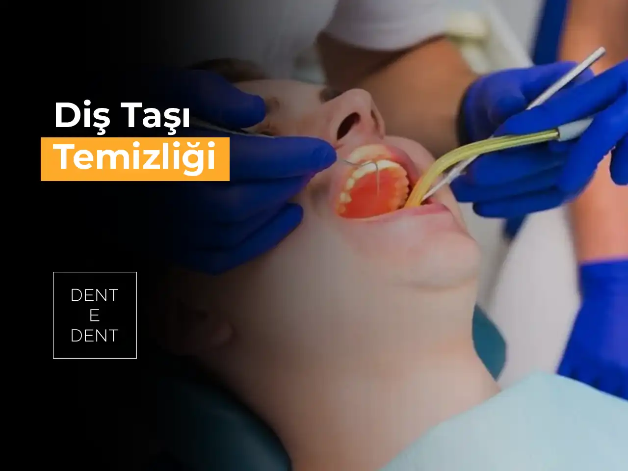 Diş Taşı Temizliği