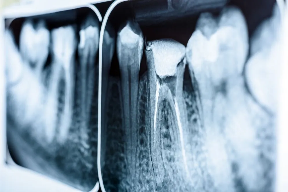 Endodonti Nedir