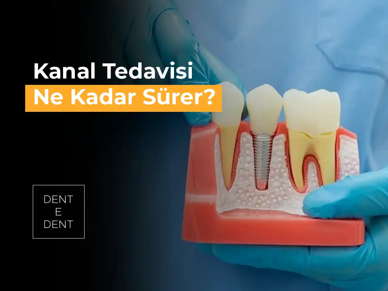 Kanal Tedavisi Ne Kadar Sürer