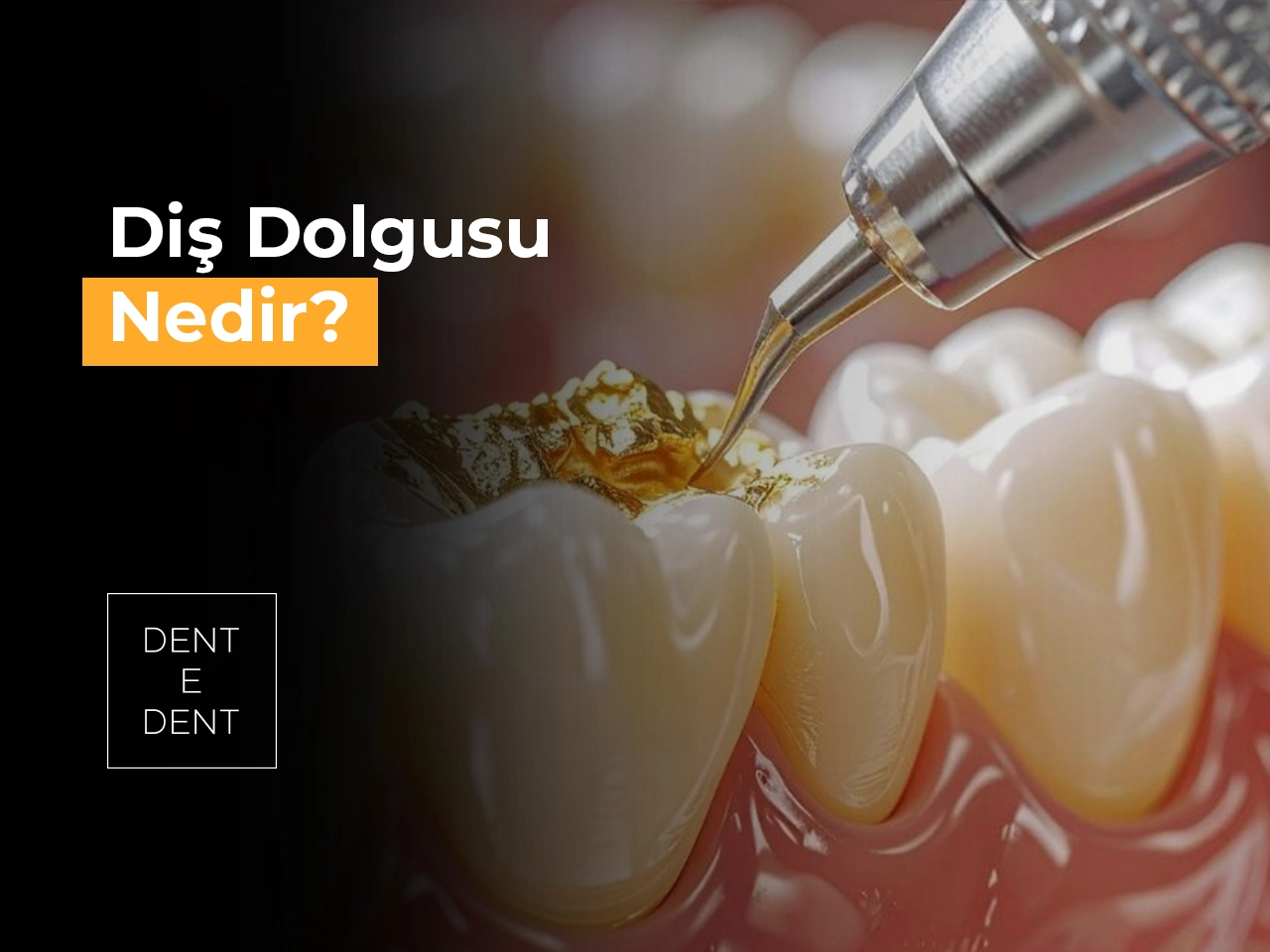 Diş Dolgusu Nedir