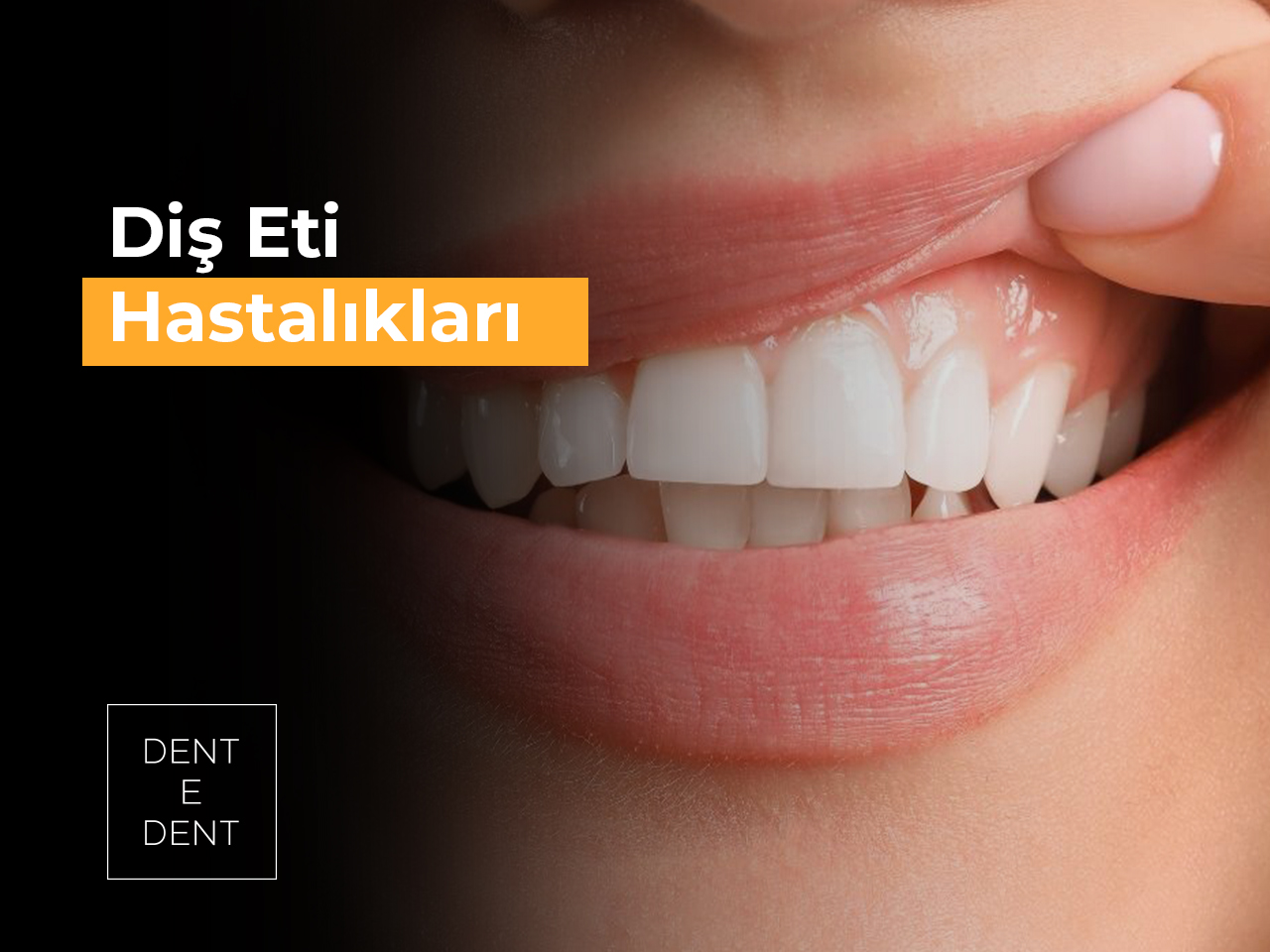 Diş Eti Hastalıkları