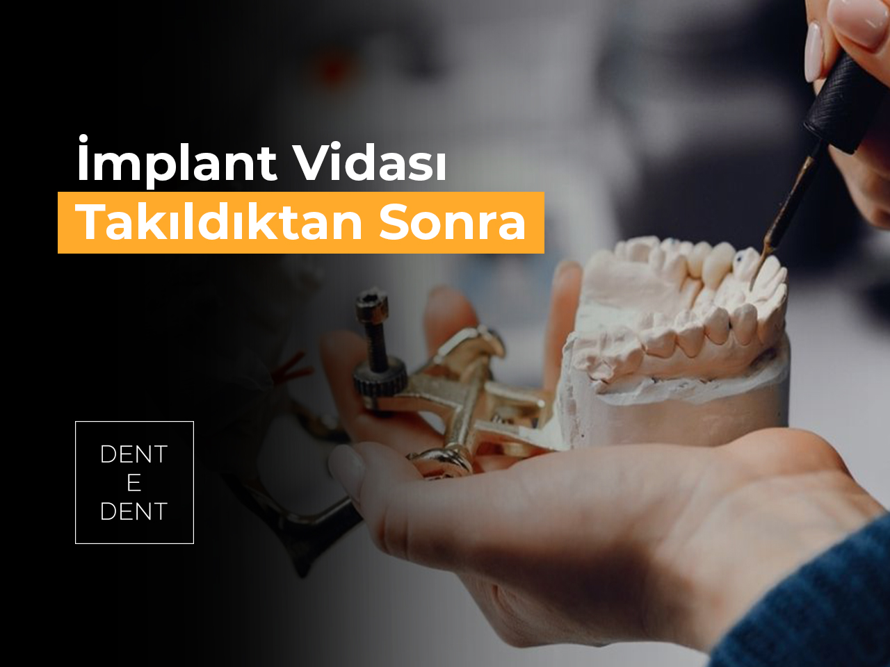 İmplant Vidası Takıldıktan Sonra Diş Ne Zaman Takılır