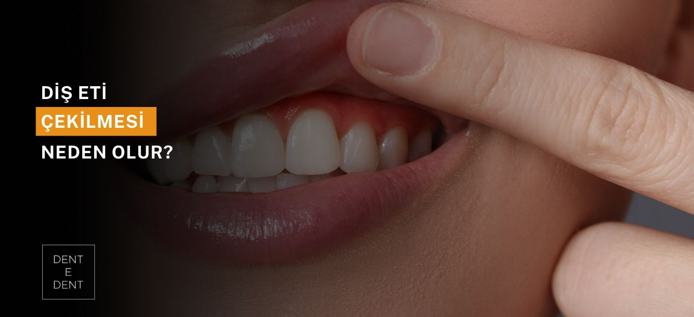 Diş Eti Çekilmesi Neden Olur?