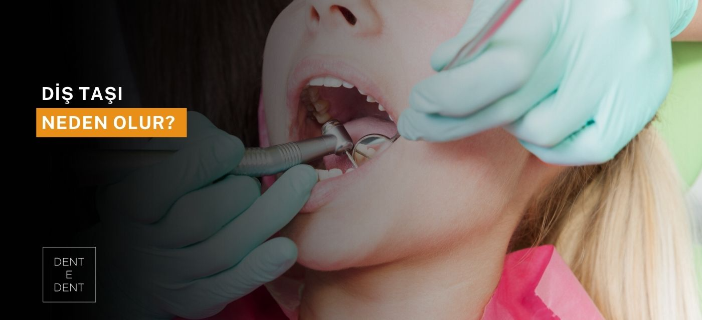 Diş Taşı Neden Olur?