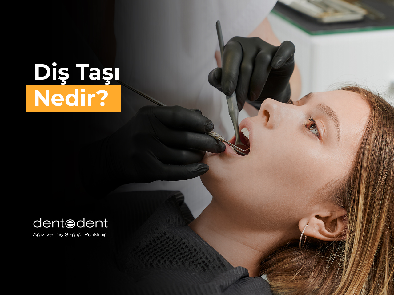 Diş Taşı Nedir?
