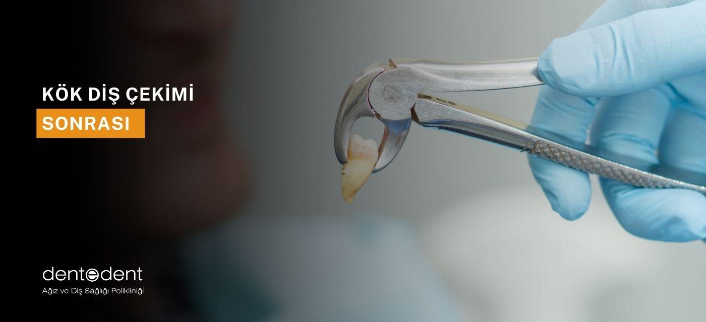 Kök Diş Çekimi Sonrası Ağrı Ne Kadar Sürer?