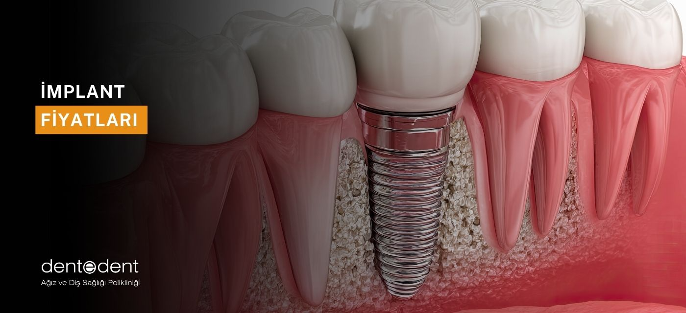 İmplant Fiyatları