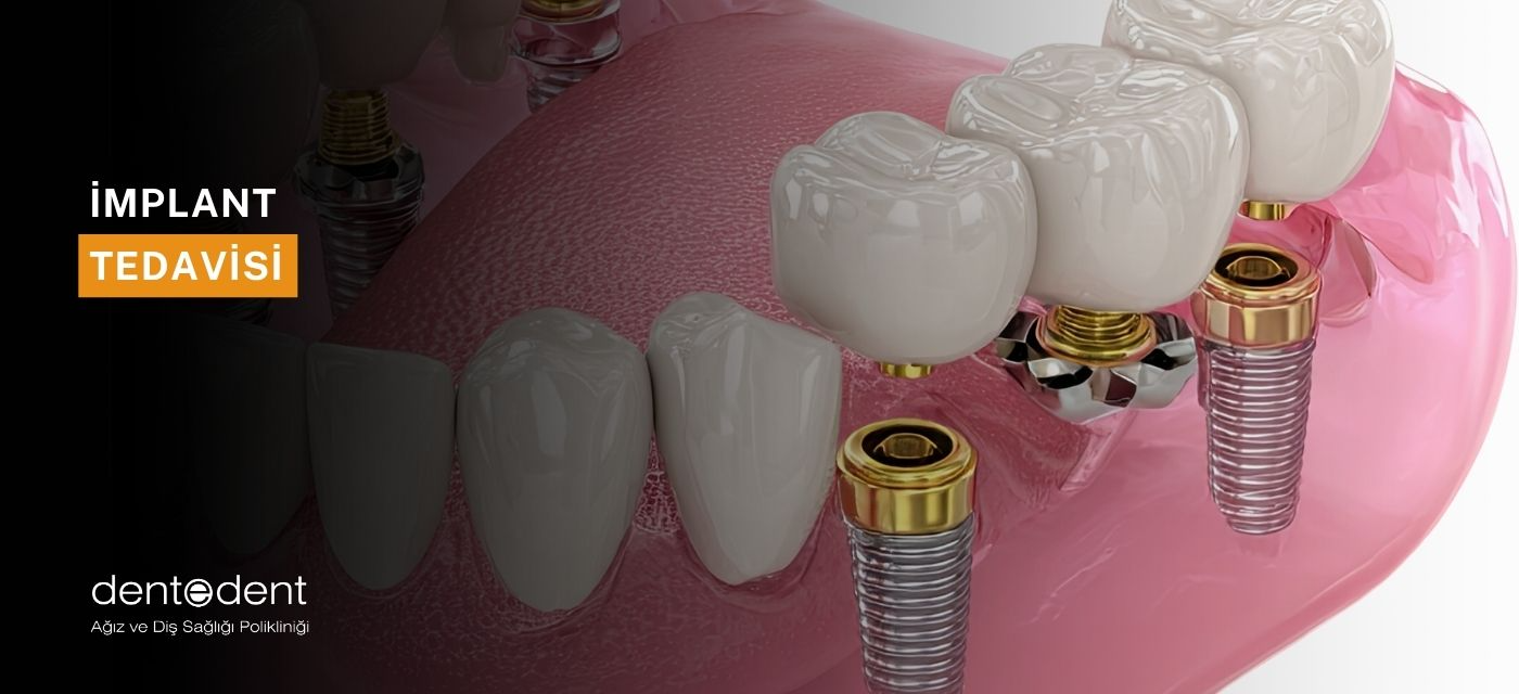 İmplant Tedavisi