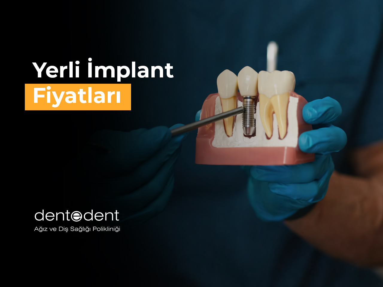 Yerli İmplant Fiyatları
